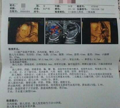 关于怀孕五个月三维彩超检测胎儿性别的准确率分析