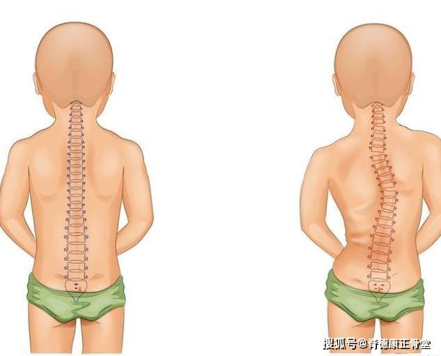 关于六个月宝宝坐着脊柱弯的分析与应对建议