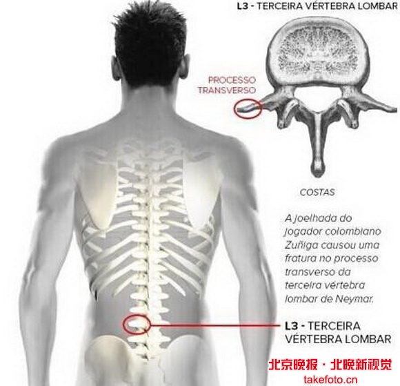 骨裂一个月还疼正常吗？解析恢复过程中的常见问题